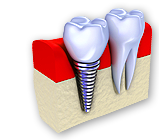 Implantálás